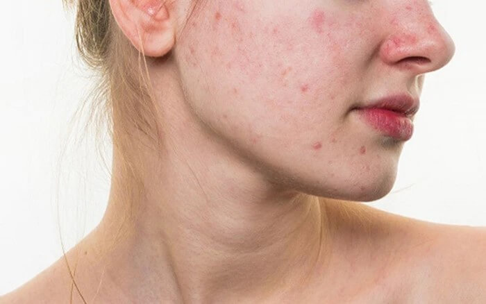 Mụn thai kỳ là gì?